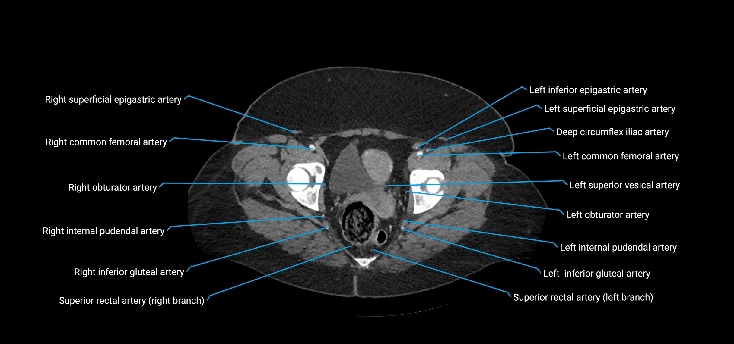 CTA abdomen axial cross sectional anatomy labelled image_237 (2).webp